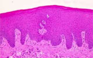 Лейкоплакия вульвы