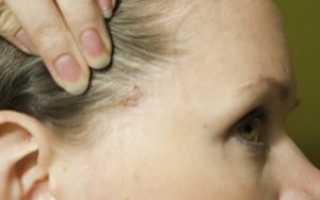 Как лечить образование в голове