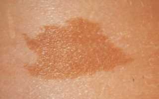 Кофейные пятна пигментация у ребенка