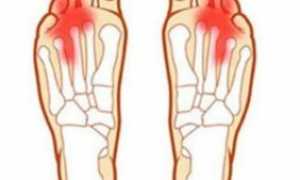 Болит палец безымянный на правой ноге при ходьбе, обувь свободная