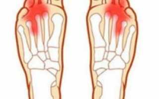 Болит палец безымянный на правой ноге при ходьбе, обувь свободная
