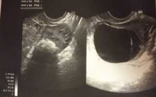 Киста ЖТ или возможность беременности