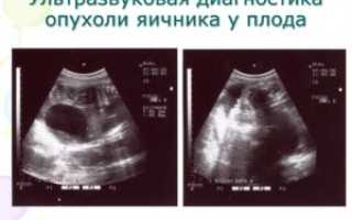 Киста яичника плода