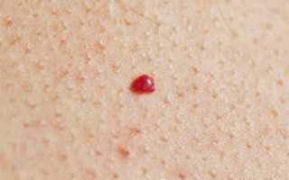 Красная точка на родинке