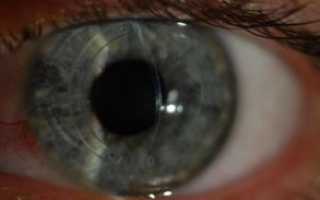 Боль в глазу после операции Кераринг