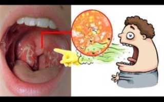 Переваренные кусочки еды во рту из желудка, очень вонючие