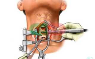 Боли после операции по удалению грыжи шейного отдела