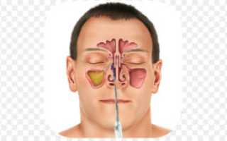 Болит пазуха носа после операции