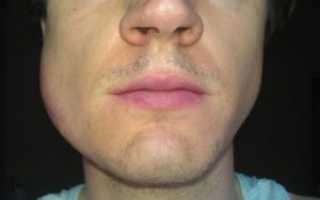 Болит челюсть, опухла щека