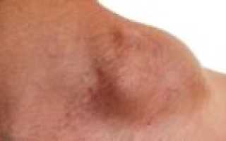 Лимфома? Потливость