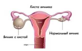 Киста у девочки