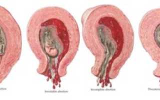 Медикаментозный аборт, плодное яйцо не вышло
