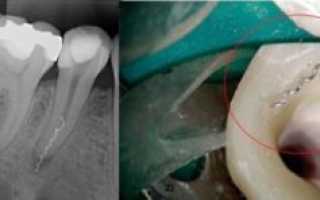 Боль в зубе после пломбирования каналов