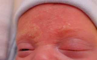 Как снять зуд у грудничка?