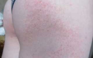 Красная сыпь после душа