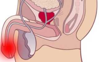 Болит головка члена