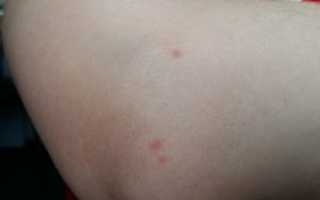 Красные пятна и боль