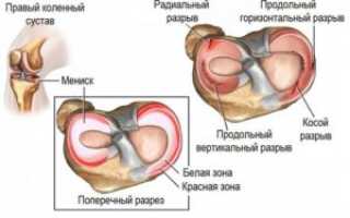 Боль в колене после операции миниска