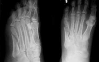 Перелом основания 2 плюсневой кости