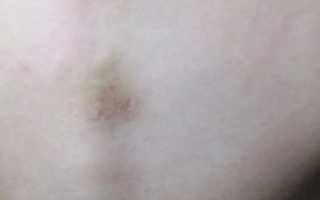 Круглое светло-голубое пятно на спине