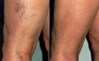 Массаж после склеротеропии