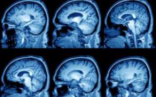 Киста головного мозга