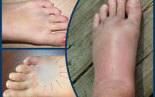 Болит и сильно отекает нога после перелома плюсневой кости