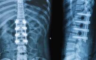 Перелом позвоночника, нужна ли мне операция