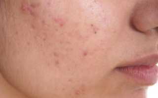 Большое количество прыщей и угрей