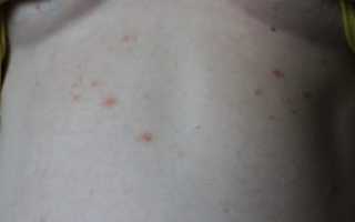 Красные пятна на торсе у мужчины