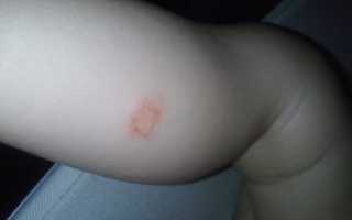 Болячка у ребенка