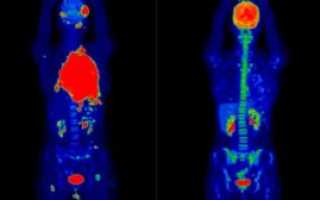 Лимфома. Расшифровка диагноза после ПЭТ/КТ исследования