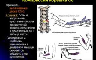 Компрессия корешков