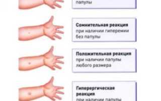 Манту при простуде