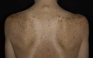 Пигментные пятна на спине