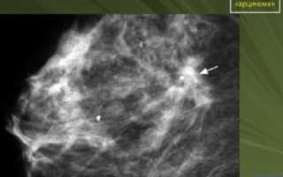 Инфильтративная дуктальная карценома