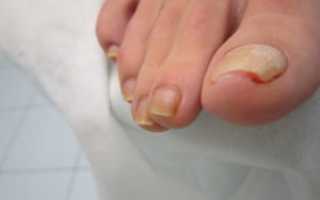 Боль в пальце через несколько дней после удаления ногтя