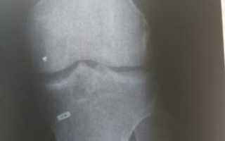 Инородное тело в колене