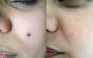 Пигмент после удаление родинки