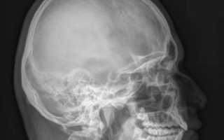 Как скоро необходимо делать рентген при ударе головой?