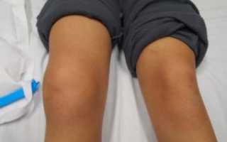 Как лечить травму колена у ребенка