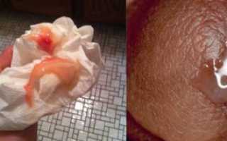 Кровяные выделения в течении месяца