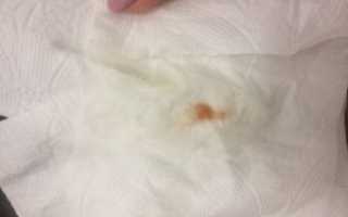 Кровотечение на 7 недели беременности