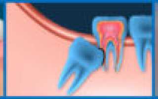 Болит десна на месте удалённого зуба