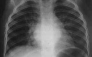 Бронхит или пневмония, расшифровка по рентгену легких