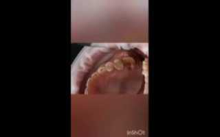 Маленький хруст в недавно пломбированном зубе