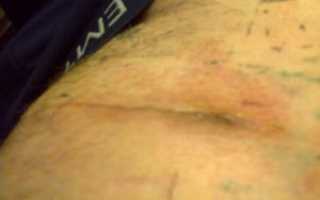 Келоидный рубец после операции паховый грыжи