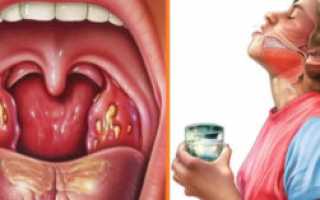 Болит горло с нутри и с наружи