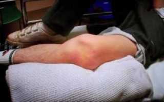 Колено ушло внутрь и встало на место