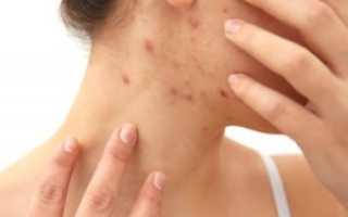 Красные высыпания прыщей, на шее сзади